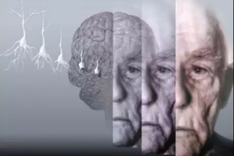 Альцгеймер отбирает у мировой экономики 1% ВВП