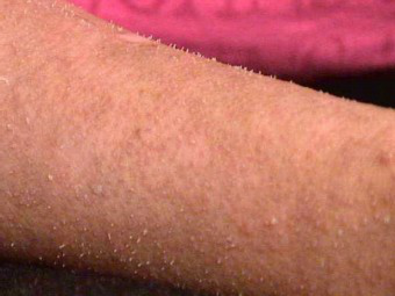 Кожный покров Шаньи Айсом. Кадр телеканала WMC-TV.