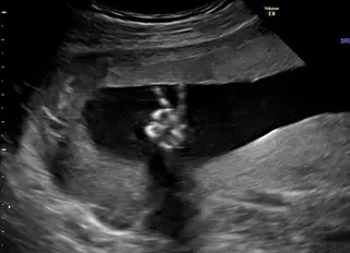 Малыш в животе показал родителям жест "победы"