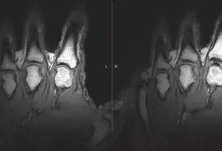 Медики раскрыли тайну хруста суставов