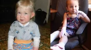 В Казахстане живут две девочки с редчайшим "синдромом бабочки"