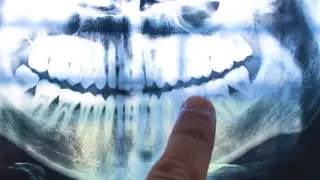 Исследование: зубы могут рассказать о болезнях, тюрьме и переезде