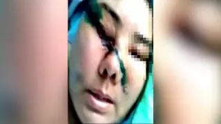 "Муж ударил топором и скрылся": женщина ослепла на один глаз