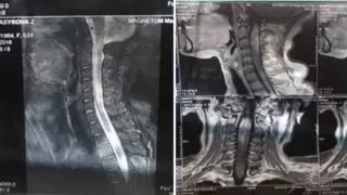 Редчайшую болезнь выявили у алматинки