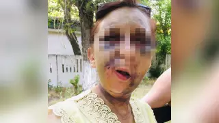 Сломаны челюсть и ребра. Задержан подозреваемый в жестоком избиении женщины