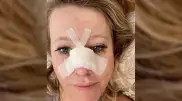 Собчак сломала нос и получила сотрясение мозга