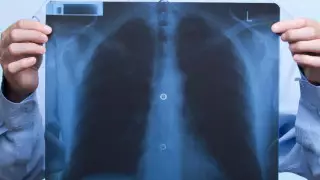 Онколог өкпе ісігі мен пневмонияны қалай ажыратуға болатынын айтты