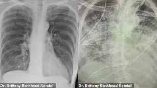 Рентгеновские снимки показали, как COVID-19 уничтожает легкие