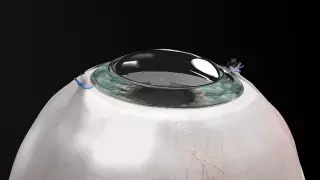 Синтетическая роговица вернула зрение слепому мужчине