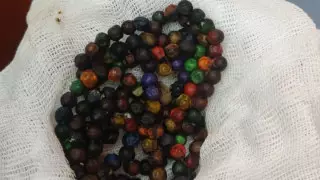 100 магнитов извлекли из желудка ребенка в Нур-Султане