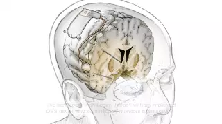 Ученые создали мозговой имплант для борьбы с депрессией