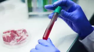 Вероятный случай конго-крымской геморрагической лихорадки зафиксирован в Шымкенте