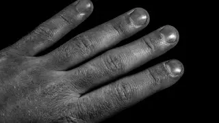 Врач рассказала, как определить высокий холестерин по пальцам рук