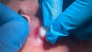 Казахстанка 25 лет прожила с осколком стекла под глазом