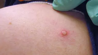 ВОЗ объявила оспу обезьян международной чрезвычайной ситуацией