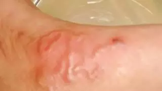 Червя-паразита обнаружили под кожей у жителя Уральска