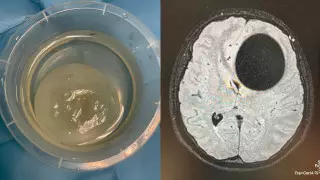 Удалили гигантский эхинококк из головы: стало известно о состоянии пациентки