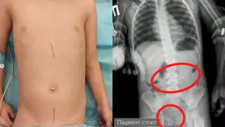 Проглотил швейные иголки: врачи спасли жизнь малышу в Таразе