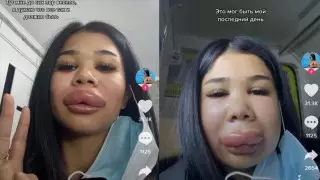 Шокирующие последствия после коррекции губ сняла на видео астанчанка
