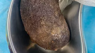 Килограмм волос извлекли из желудка 11-летней девочки в Алматы