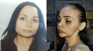 Повреждение нерва, сгнившие кости. Жительнице Атырау испортили лицо в результате пластической операции