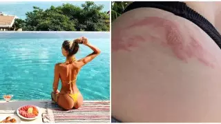 Туристка покрылась жуткими волдырями из-за насекомого на Бали