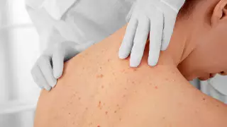 Раскрыты пять неожиданных симптомов рака кожи