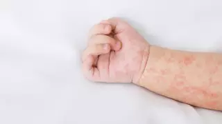 Корь в Алматы: в каком случае учеников школ могут перевести на онлайн-обучение