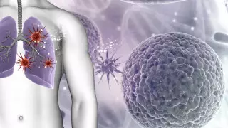 Назван неочевидный симптом развития рака легких