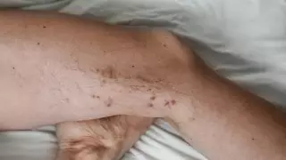 Врачи назвали "молчаливый" симптом тромбоза