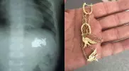 Золотые украшения извлекли из желудка малыша в Кызылорде