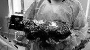 "Плакал от радости". Пациенту вырезали девятикилограммовую опухоль в Шымкенте
