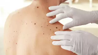 Названы виды родинок, которые обязательно нужно удалять