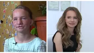 Изувеченной родными алматинке подарили новое лицо