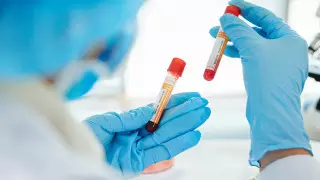 Сколько случаев заражения корью фиксируют ежедневно в Астане