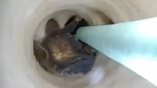 Опасных паразитов обнаружили врачи в желчных путях пенсионера