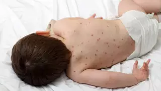 Пятеро детей с корью в тяжелом состоянии попали в реанимацию в Актобе