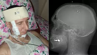 Россиянин, просверливший себе череп в Алматы, решил уехать в США