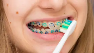 Можно ли поставить ребенку брекеты бесплатно по медстраховке