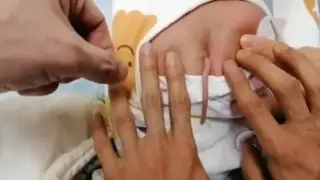 Уникальный ребенок с 10-сантиметровым хвостом родился в Китае