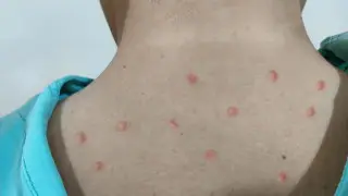 Больницы Казахстана обязали подготовиться к завозу вируса Mpox