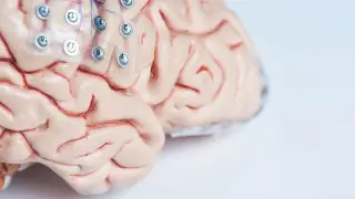 Парализованные пациенты сделали первые шаги благодаря мозговым имплантам