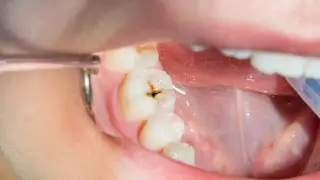 Ученые нашли самый простой способ усилить защиту зубов против кариеса