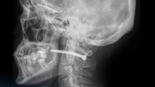 Казахстанец выстрелил себе в шею гвоздём