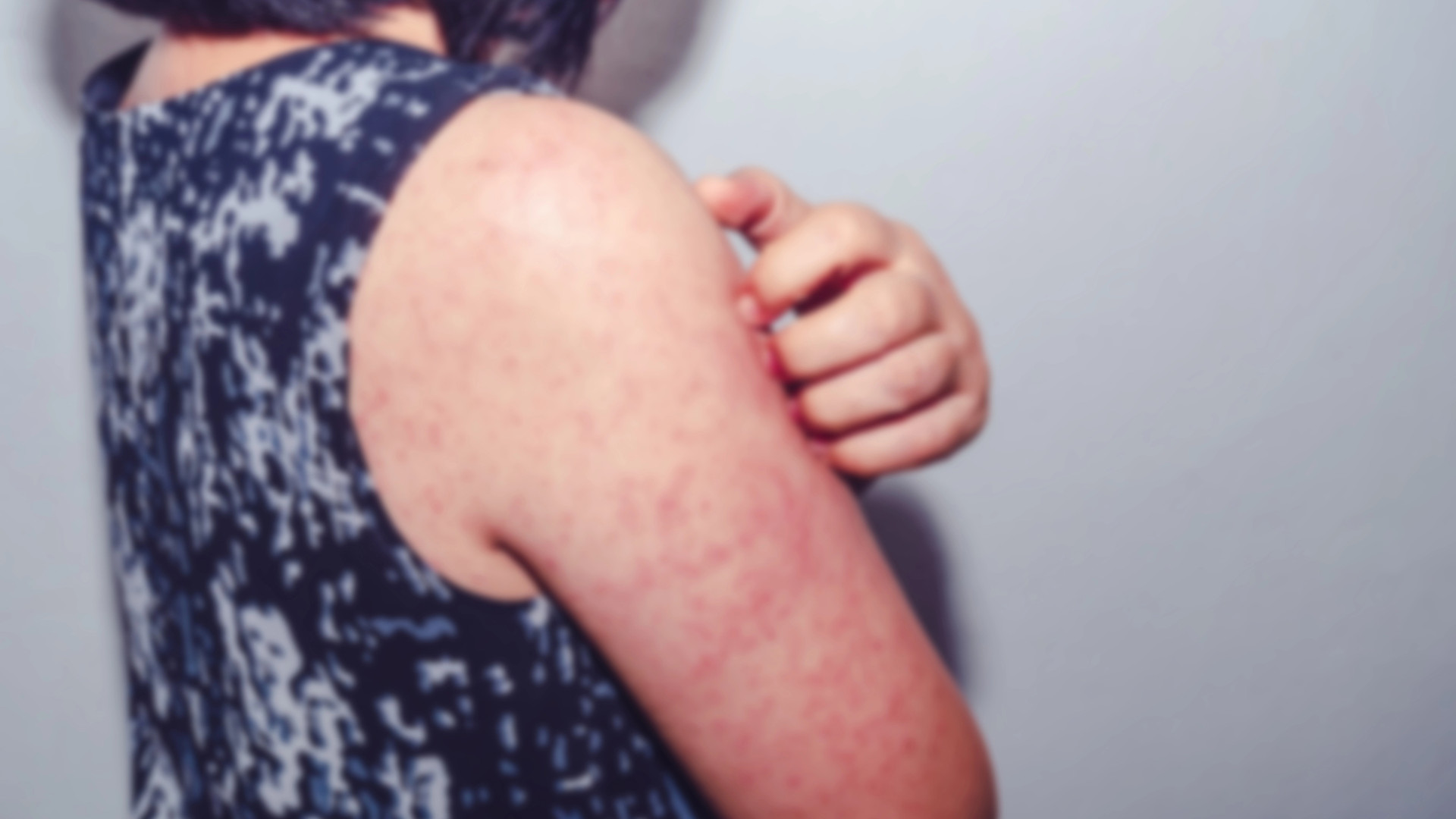 Снова вспышка кори? В Казахстане заболели сотни детей