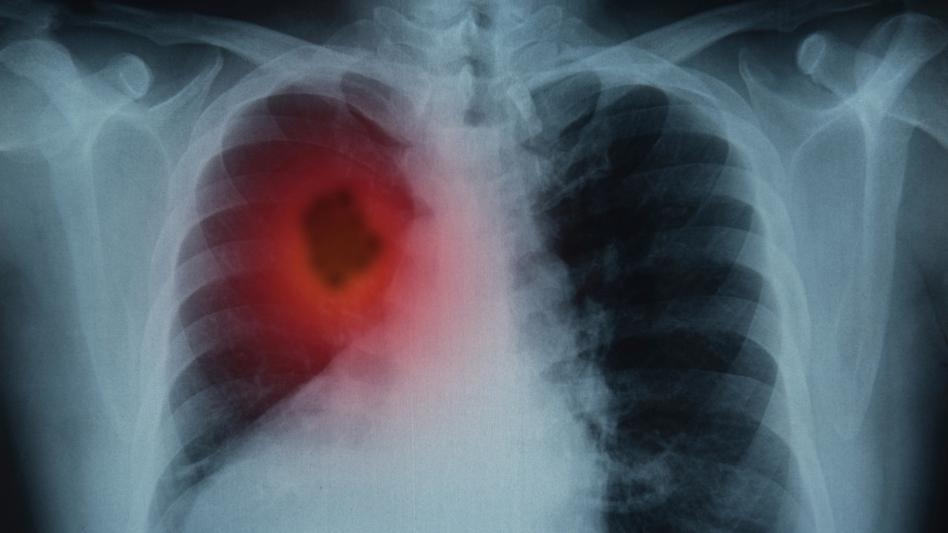 Врач назвал эффективный способ выявления рака легкого