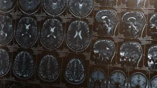 Названа простая привычка, снижающая риск деменции почти на 40 процентов