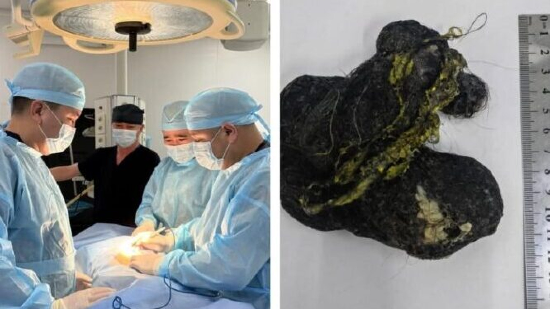 В Шымкенте из желудка ребенка извлекли 15-сантиметровый ком волос