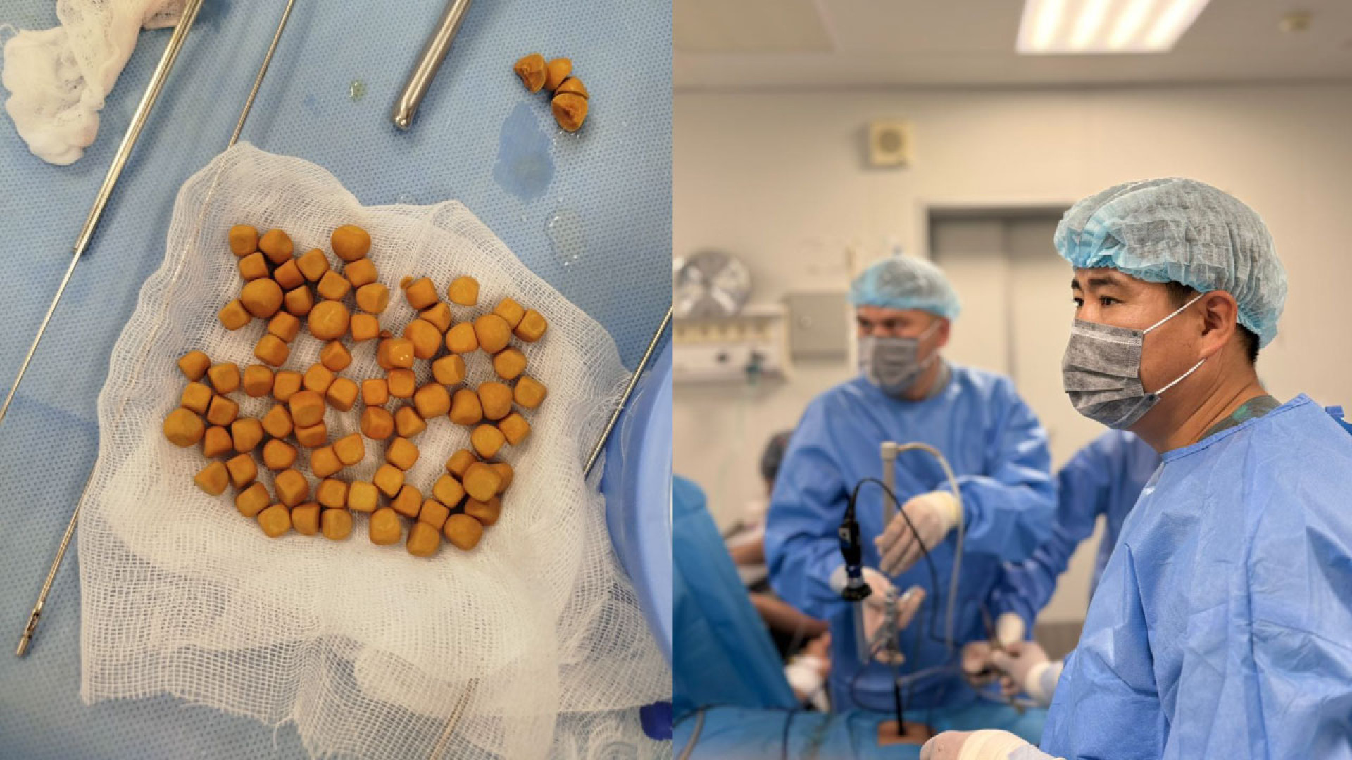Врачи извлекли 80 камней из мочевого пузыря 61-летнего казахстанца